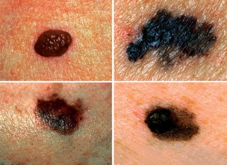 C dermic от папиллом отзывы
