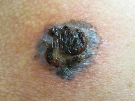 C dermic от папиллом отзывы